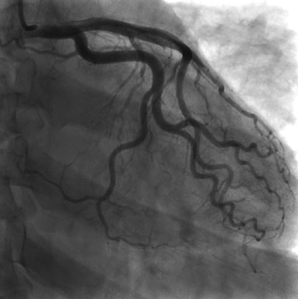 Coronary angiography showed no remarkable findings on the left coronary artery.
