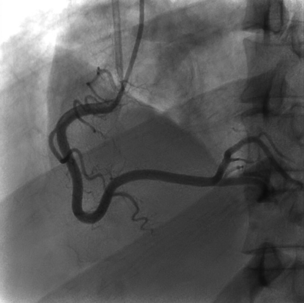 Coronary angiography showed no remarkable findings on the right coronary artery.
