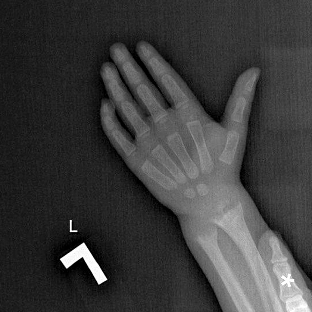 X-ray of left wrist showing splaying and fraying of metaphysis of radius and ulna. *Finger of the patient’s mother.