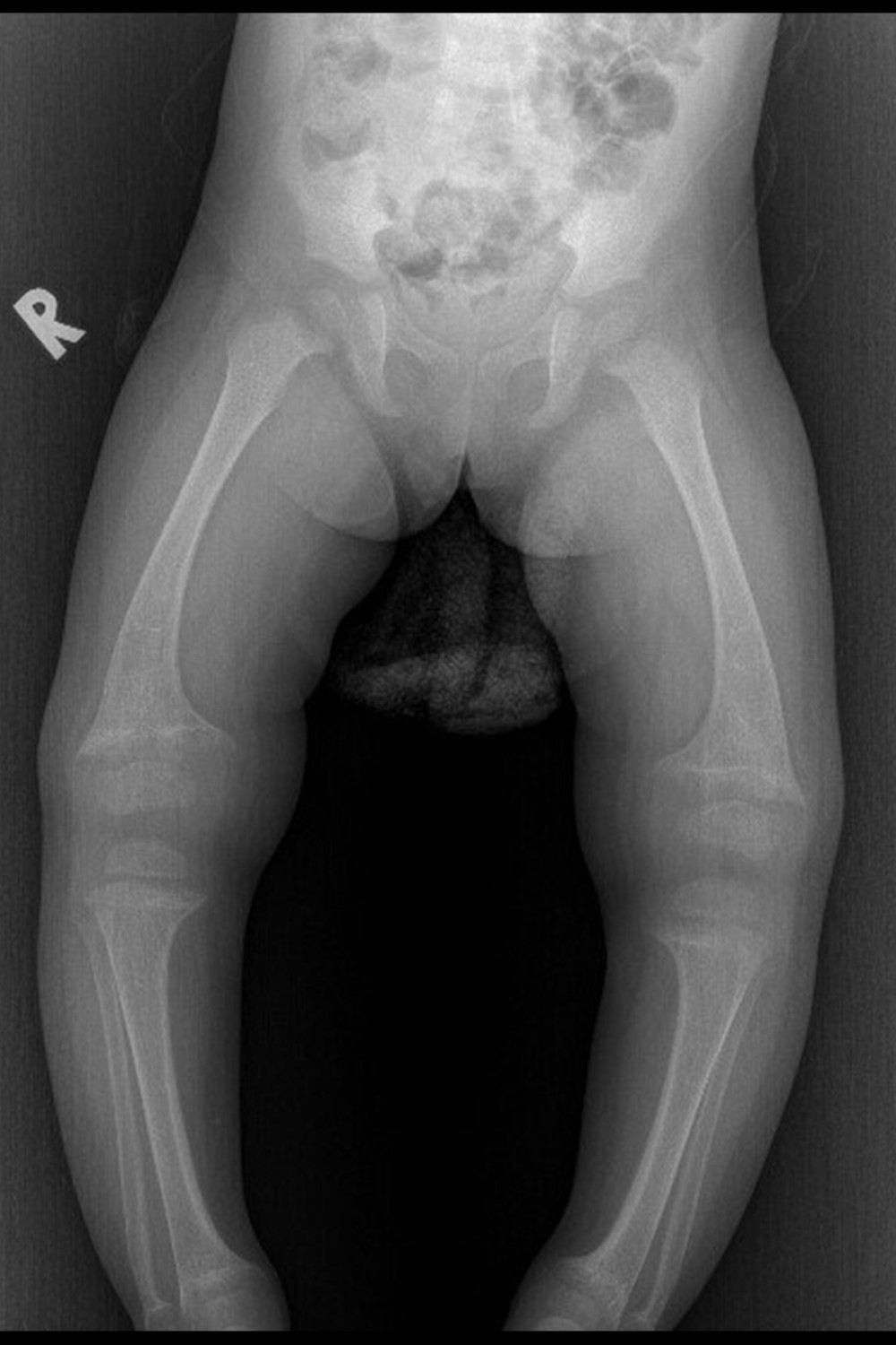 X-ray of lower limbs showing bowing of legs and widened metaphysis on bilateral knee joints.