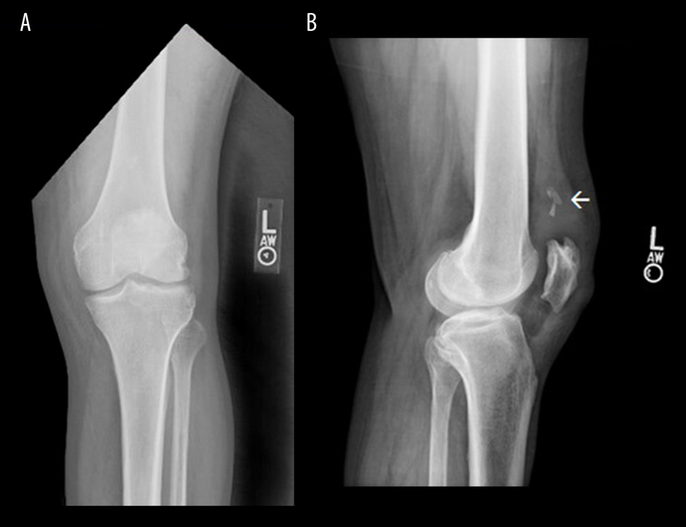 Preoperative anteroposterior (A) and lateral (B) radiographs of the left knee show bony avulsion fracture (arrow) of the superior pole of the patella.