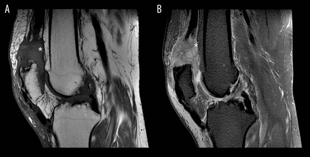 Sagittal views of T1 (A) and T2-weighted (B) left knee magnetic resonance imaging show complete tear of the quadriceps tendon just proximal to the superior pole of the patella with 3 cm of tendon retraction and patella baja. The “*” denotes the area where the tendon was avulsed.