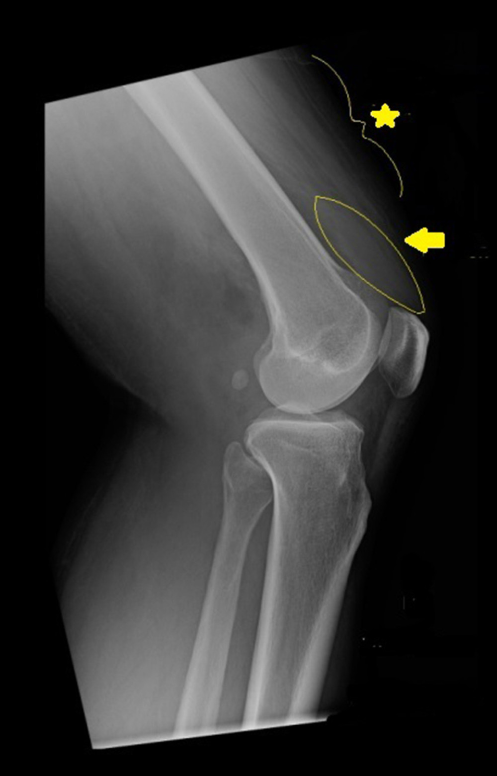 Right knee radiograph with joint effusion (star) and soft tissue swelling (arrow).