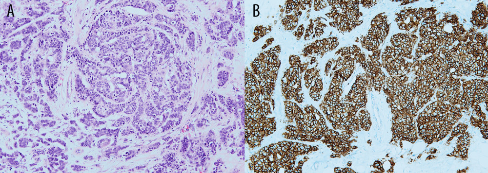 Microscopic appearance of the tumor showing typical histologic appearance of invasive ductal carcinoma, no special type (A: Hematoxylin & Eosin, ×100), with Her-2 immunophenotype (B: Her-2 immunohistochemistry, ×100).