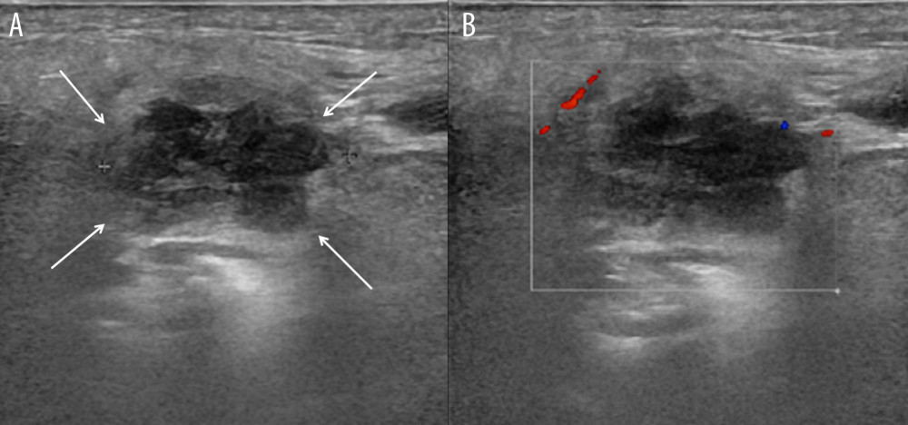 Longitudinal ultrasonography (A) shows a 2-cm heterogeneous echogenic mass with indistinct margins and irregular shape in the left parotid gland (arrows). Color Doppler ultrasonography (B) shows a weak rim vascularity around the mass.