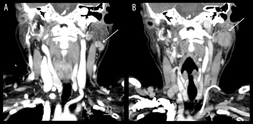Contrast-enhanced computed tomography scan of the neck that 6 months prior (A) shows a 1.3-cm irregular mass with relatively circumscribed margins and heterogeneous enhancement in the inferior pole of the left parotid gland (arrow). Follow-up computed tomography scan of the neck (B) shows interval increase of the mass with irregular shape and margins and heterogeneous enhancement in the left parotid gland (arrow).