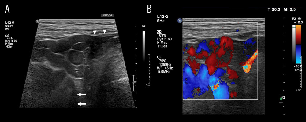 Grayscale ultrasound and color Doppler ultrasound imaging of the right inguinal region. (A) Grayscale ultrasound imaging of the right inguinal region shows multiple echo-free serpiginous tubular structure structures within the right inguinal canal (arrowhead) extending into the right para-uterine space (arrow). (B) These structures demonstrate increased vascularity on color Doppler ultrasound with marked flow augmentation on Valsalva maneuver. There was no ultrasonographic evidence of an inguinal hernia. The imaging findings were consistent with round ligament varices (RLV).