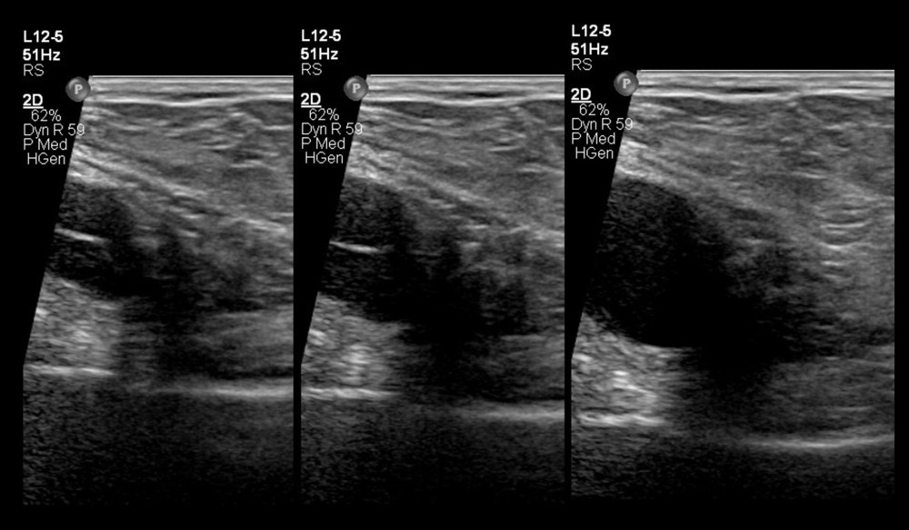 Grayscale ultrasound imaging of the right iliac fossa on Valsalva maneuver shows dilatation and increased prominence of the varices.