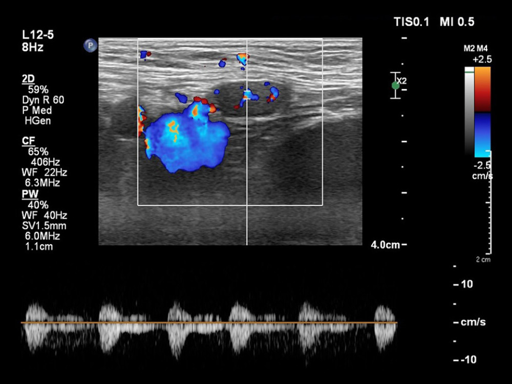 Color Doppler interrogation of the varices demonstrates a venous flow pattern with mirror artifact. No signs of venous thrombosis or rupture were detected.
