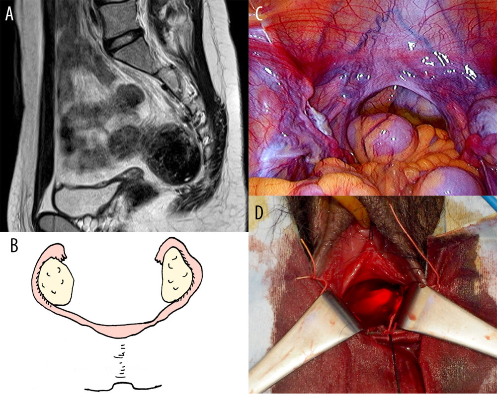 (Case 1). (A) MRI findings (T2-weighted imaging, sagittal plane) revealed vaginal aplasia and rudimentary uterus. Mayer-Rokitansky-Küster-Hauser syndrome was diagnosed. (B) Schematic representation of the genital organs seen in Case 1. (C) Intraoperative findings revealed that blood vessel damage could be avoided by advancing the scope to the blind end of the vagina between the bladder and rectum and then bluntly dissecting the connective tissue between the bladder and rectum in the direction of the light. (D) Use of the light of the laparoscope as a landmark for blunt dissection of the connective tissue between the bladder and rectum from the vaginal side.