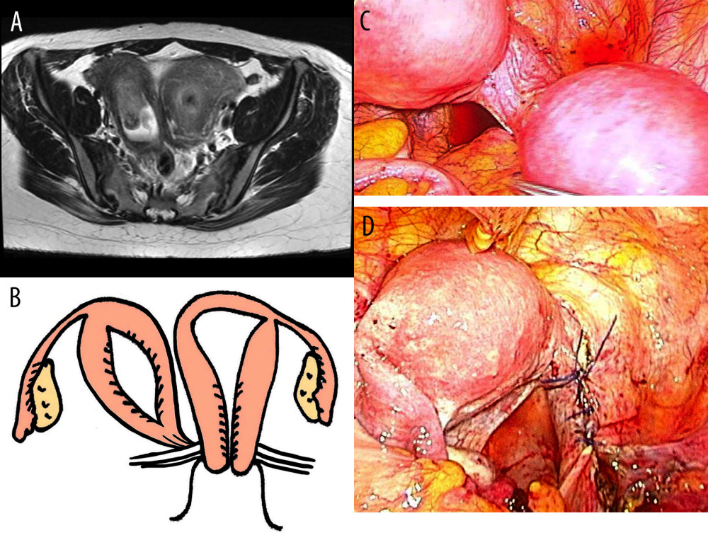 (Case 2). (A) MRI findings (T2-weighted imaging, axial plane) revealed duplicated uterus; however, continuity between the uterine cavity and vaginal cavity on the right side could not be confirmed. (B) Schematic representation of the genital organs seen in Case 2. (C) Intraoperative findings revealed that the right affected uterus was connected to the parauterine connective tissue of the left normal uterus by a cord-like structure. (D) The affected uterus was resected and removed laparoscopically.