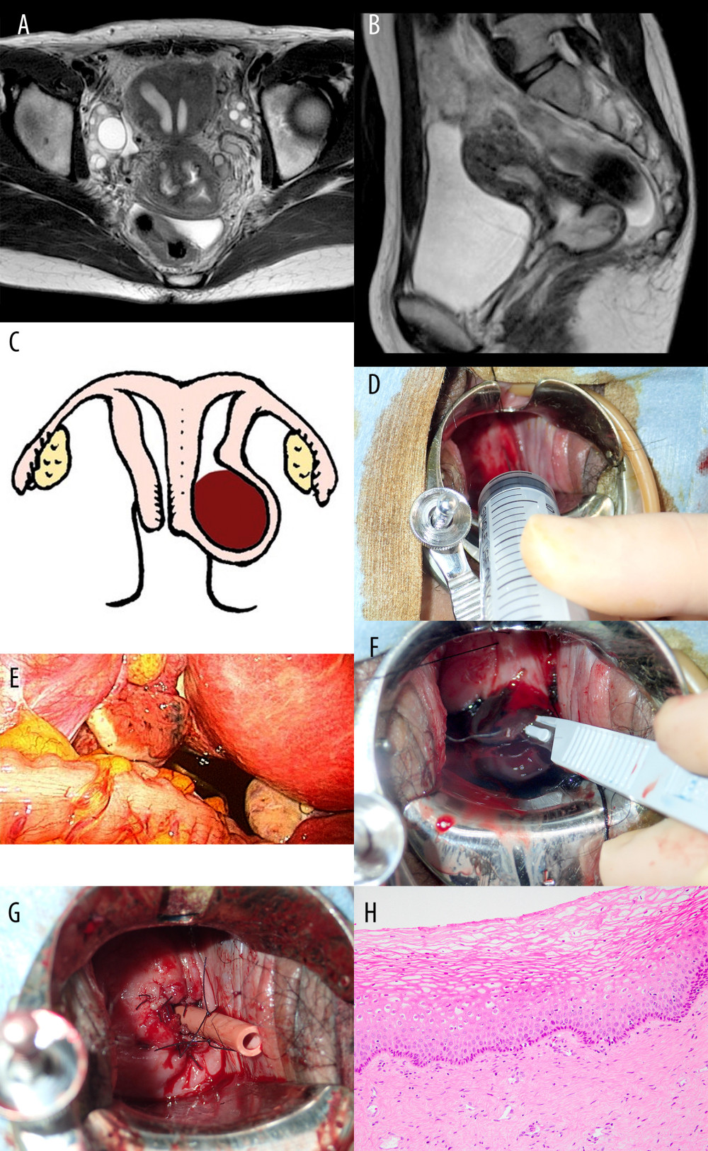 (Case 4). (A) MRI findings (T2-weighted imaging, axial plane): Duplicated uterus was observed. (B) MRI, sagittal plane: A hemorrhagic cyst was observed in the uterine cervix of the affected side. (C) Schematic representation of the genital organs seen in Case 4. (D) Exploratory puncture was performed at the site where the uterine cervical cyst was expected, and indigo carmine was injected. (E) Pigment outflow was laparoscopically observed from the left tubal fimbriae, thereby confirming that the puncture site had entered the uterine cavity of the affected side. (F) Spreading of the puncture site with a scalpel. (G) Insertion of a large Nelaton catheter to prevent restenosis. (H) Histology of the fenestrated vaginal wall, composed of stratified squamous epithelium.