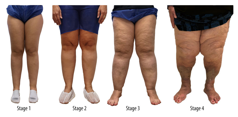 Classification of lipedema by evolutionary stages [21]. Stage 1: normal skin with an enlarged hypodermis; Stage 2: unevenness of the skin texture with pleats of fat and large piles of tissue growing like unencapsulated masses; Stage 3: hardening and thickening of the subcutaneous with large nodules and protrusion of cushions/accumulations of fat, especially in the thighs and around the knees; Stage 4: lipedema with lymphedema, so-called lipolymphedema.