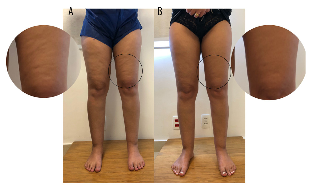 Patient with stage 1 lipedema before (A) and after (B) treatment, showing significant aesthetic improvement of gynecoid lipodystrophy (cellulitis), although it was not the main objective of the treatment.