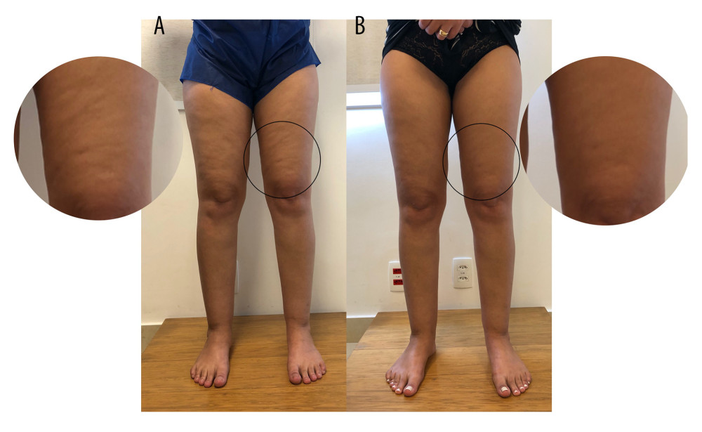 Example of clinical images of patients with lipedema (top) and