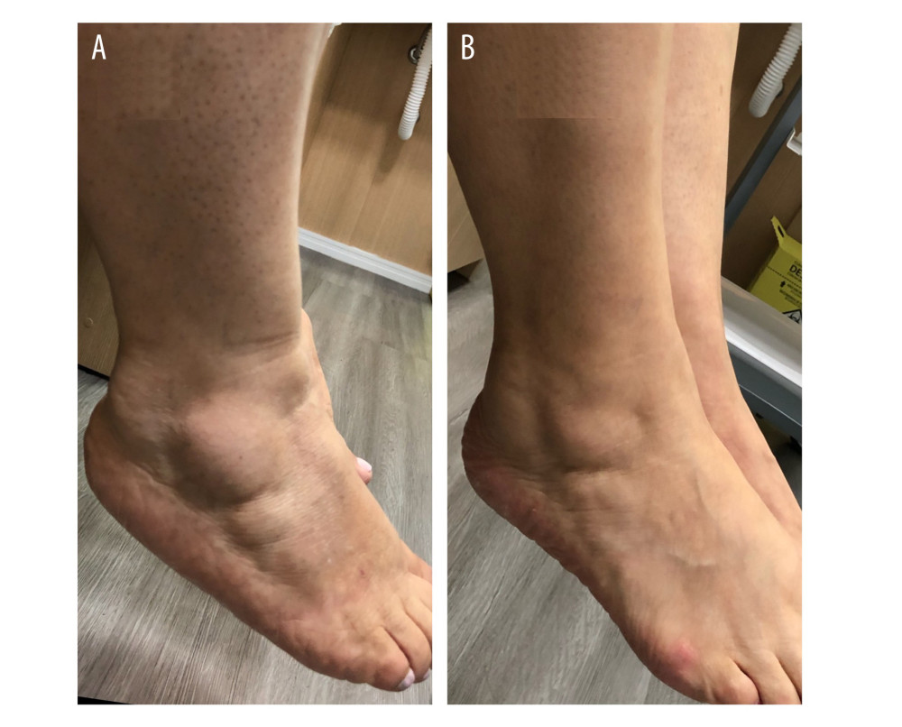 Decrease in painful fat nodules in the lateral malleolus in a patient with stage 1 lipedema. (A) Before. (B) After.