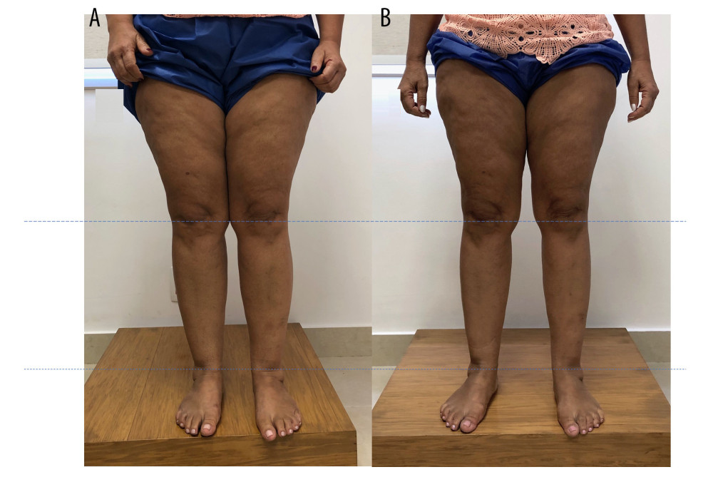 Patient with stage 2 lipedema (A), showing a slight improvement and decrease in fat deposition in the lower limbs (B).