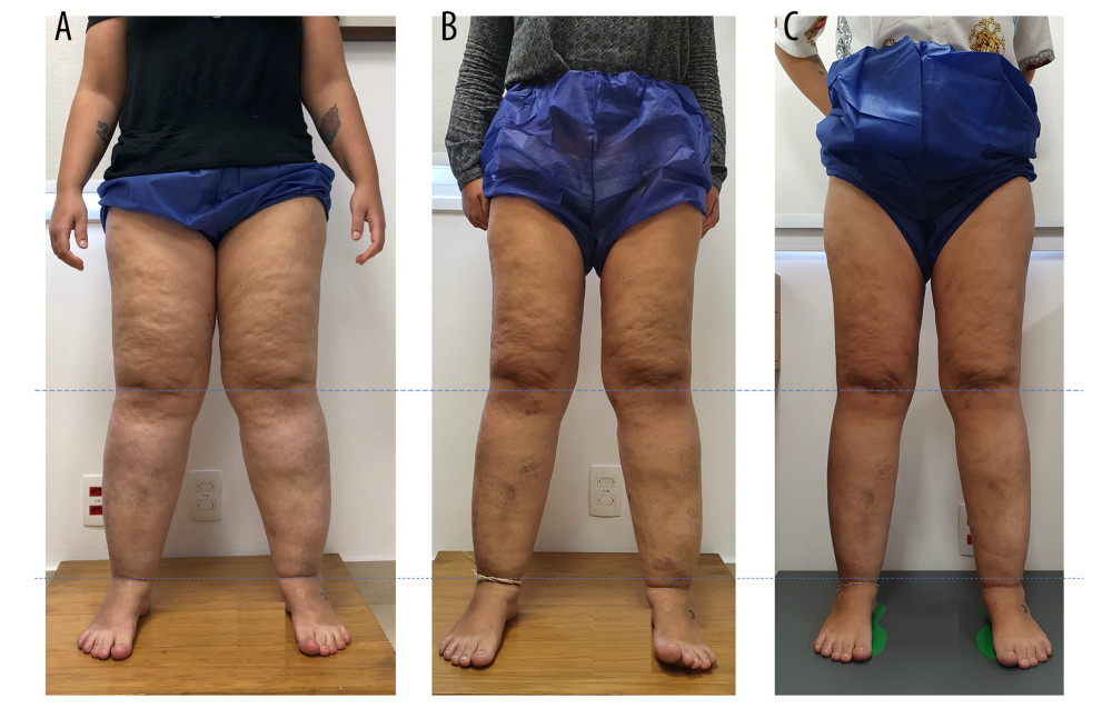 Patient with stage 3 lipedema (A), with significant improvement in fat deposition and volume in the lower limbs in 6 months (B) and 11 months (C).