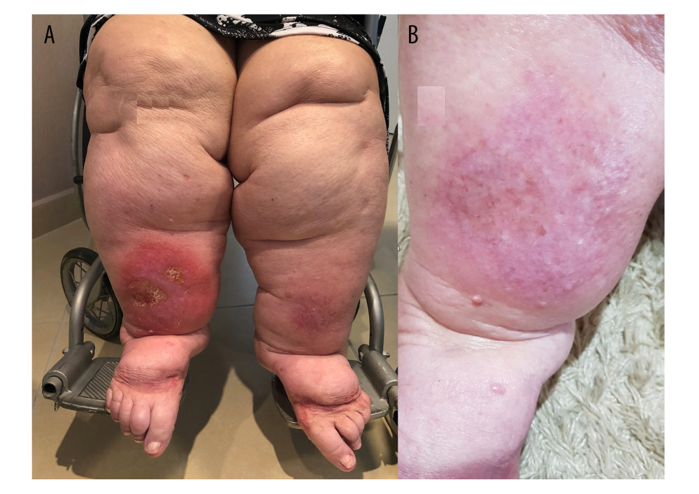 Patient with lipolymphedema, stage 4 lipedema, with erysipelas that was difficult to treat before (A) and after (B) non-surgical treatment for lipedema.