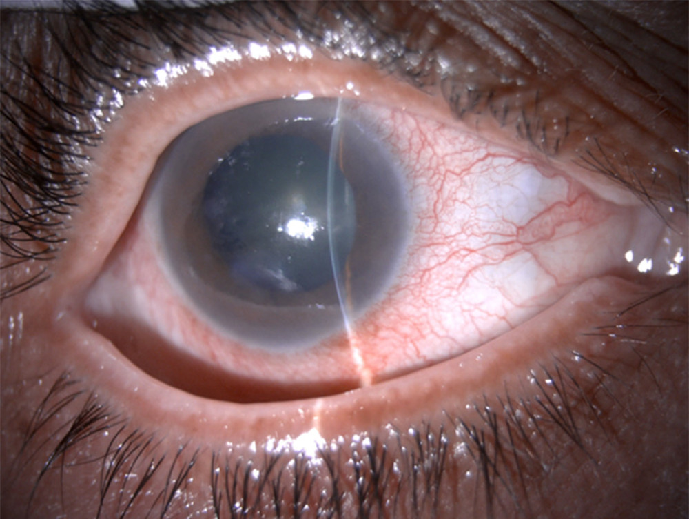 An external photo with a slit beam of the right eye demonstrating hyperemic conjunctiva, microcystic corneal edema, mid-dilated pupil, shallow anterior chamber (AC) with iris bombe, and early nuclear sclerosis.