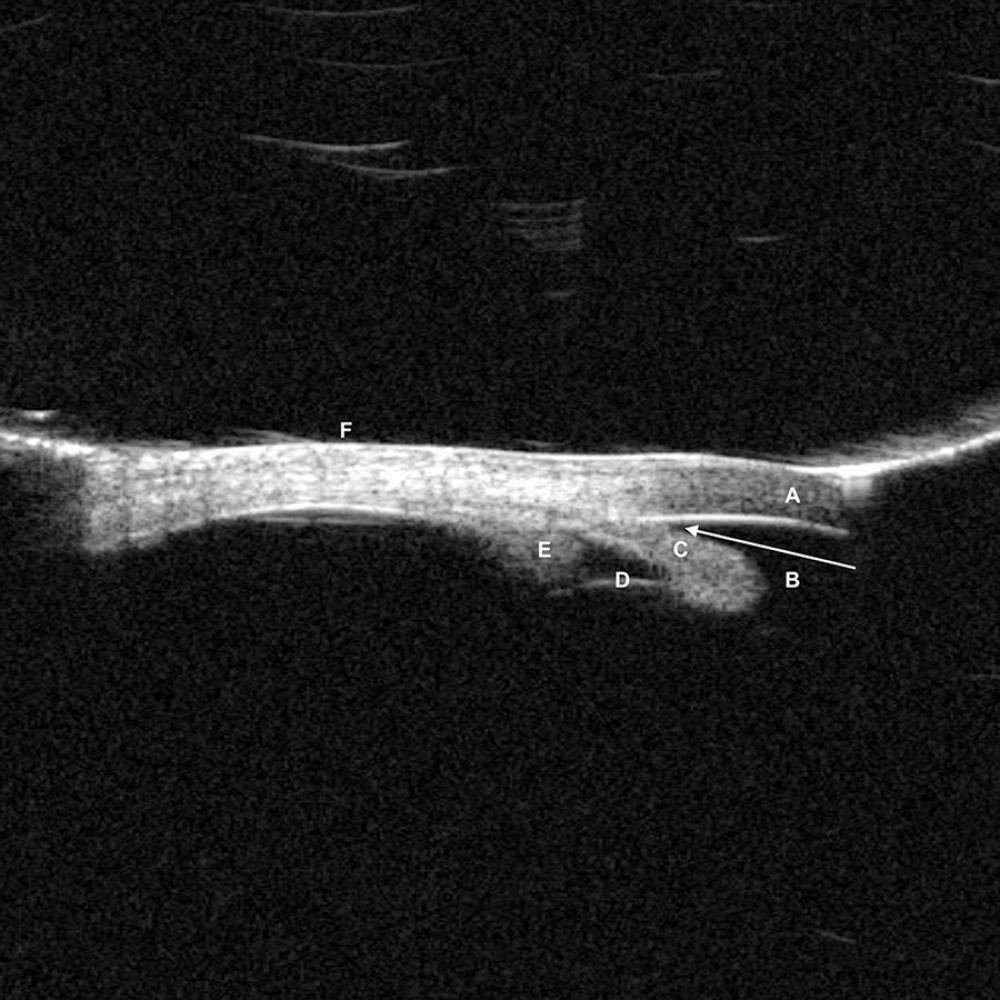 Ultrasound biomicroscopy of the right eye showing closed angle (at the arrow) 360 degrees, with no evidence of choroidal effusion. A: Cornea, B: Anterior Chamber, C: Iris, D: Anterior Lenticular Surface, E: Ciliary Body, F: Anterior Scleral Wall.