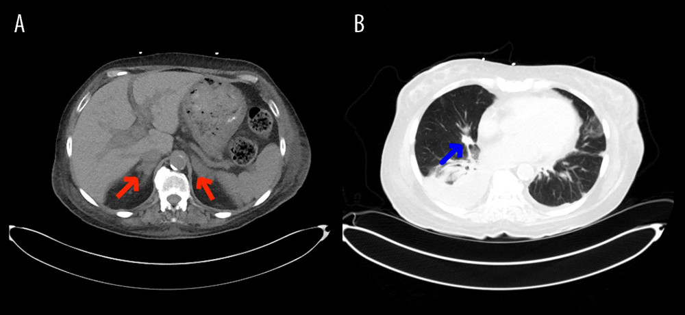 CT chest, abdomen, and pelvis w/o contrast showed bilateral enlargement of adrenal glands (A, red arrows) and a 1.4-cm nodule in the right middle lobe of the lung (B, blue arrow).