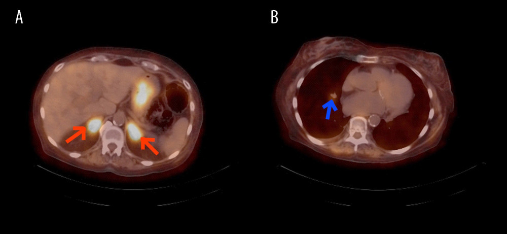 Whole-body PET/CT following intravenous injection of 40 mCi FDG showed diffuse enlargement of the bilateral adrenal glands with mSUV of 9.2 on the left and 9.1 on the right adrenal gland, respectively (A, red arrows) and low-grade activity with an MSUV of 1.4 in right lung nodule (B, blue arrow).