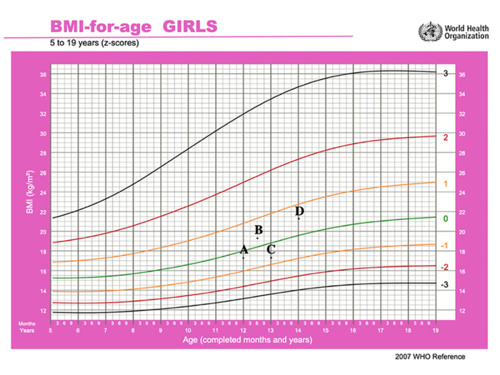 This graph represents the body mass index (BMI-for-age) based on the World Health Organization method. (A) At the onset of the disease with BMI of 17.3 kg/m2; (B) When she was on infliximab 10 mg/kg every 8 weeks and azathioprine 2.5 mg/kg), her BMI was 19.3 kg/m2. (C) When she relapsed after failing infliximab with BMI of 17.3 kg/m2. (D) The current body mass index BMI is 21.2 kg/m2.