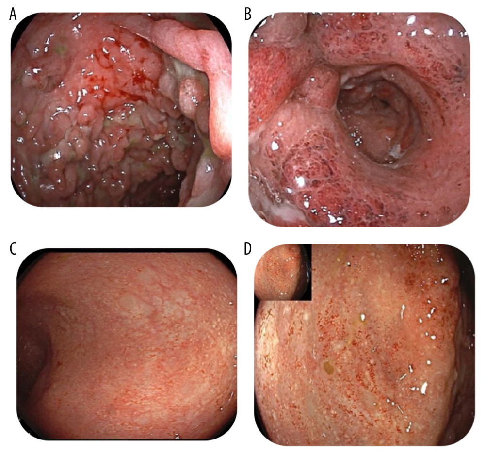 PicturesA and B showing the rectum and sigmoid colon, respectively, before starting tofacitinib, with severe ulcerations, inflammation, loss of vascularity, pseudopolyps, and severely deformed lumen. Pictures C and D showing the rectum and sigmoid, respectively, 9 months after starting tofacitinib, with no ulcerations or erosions except for mild patchy erythema.