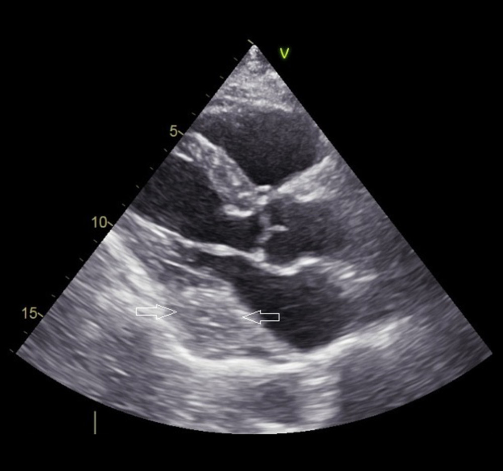 Two-dimensional transthoracic echocardiography. The parasternal long-axis view shows a large homogeneously echogenic mass (arrows) in the pericardial cavity, and it is adjacent to the left atrium and the inferolateral wall of the left ventricle with clear boundary.
