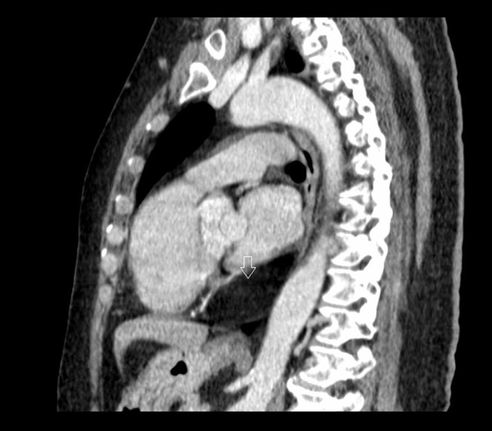 Contrast-enhanced computed tomography with coronal reconstruction shows a large encapsulated homogeneous low-attenuation mass (arrow) without internal septa, filling the pericardial cavity.