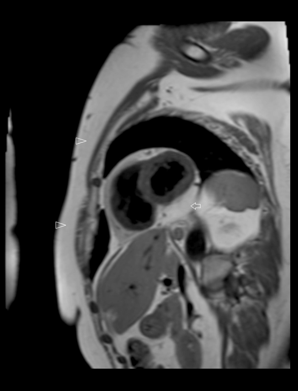 T1-weighted magnetic resonance imaging shows a large mass (arrow) in the pericardial cavity with homogeneous high signal intensity in relation to the myocardium and same signal intensity with chest wall fat tissue (arrowheads).