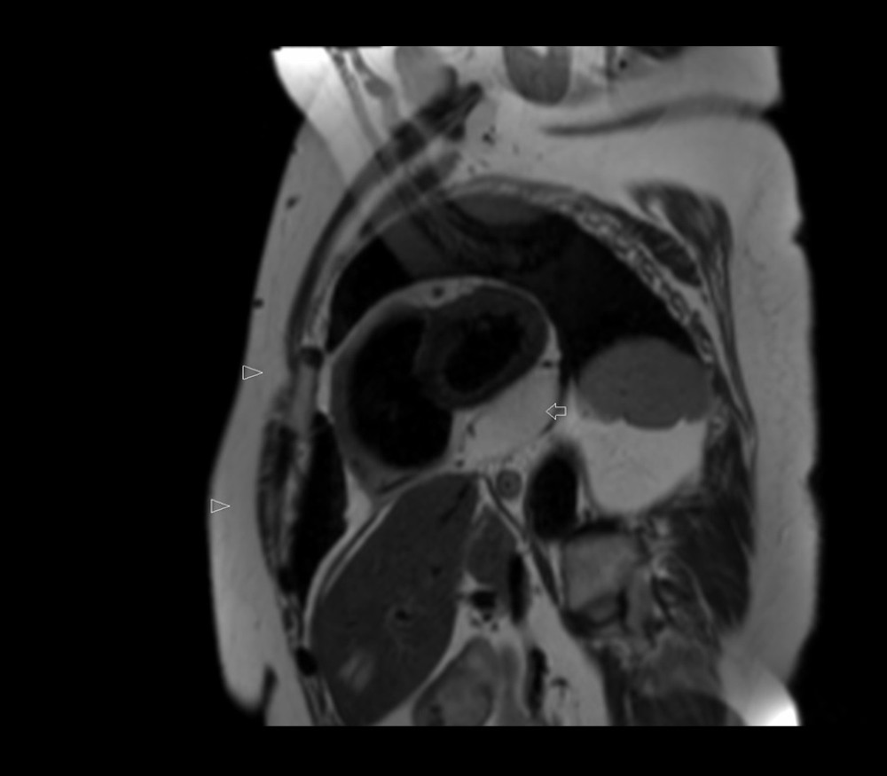 T2-weighted magnetic resonance imaging shows a large mass (arrow) in the pericardial cavity with same signal intensity with chest wall fat tissue (arrowheads).