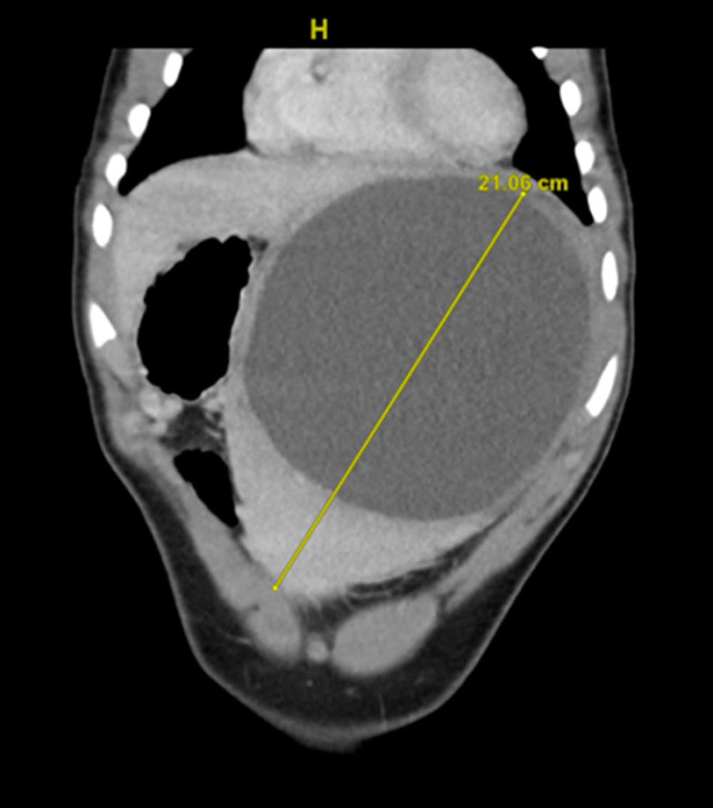 Coronal view of the abdominal computed tomography scan, revealing a large splenic cyst displacing the stomach, with a craniocaudal dimension of 21.06 cm.