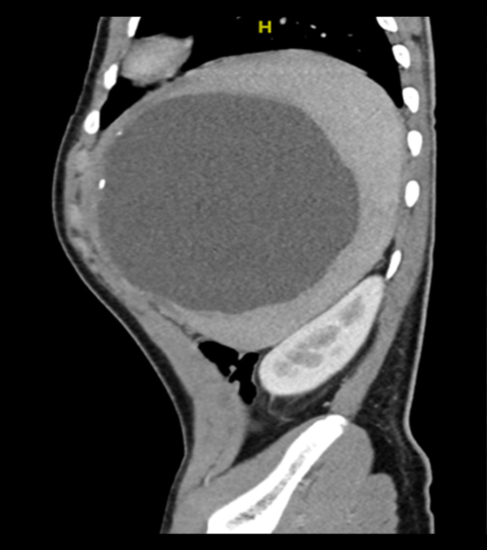 Sagittal view of the abdominal computed tomography scan, revealing a large splenic cyst with multiple foci of mural calcifications.