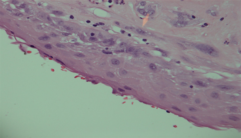 High-power microscopic view of the cyst lining, showing that the splenic cyst was lined by squamous epithelium. Hematoxylin and eosin staining, ×400.