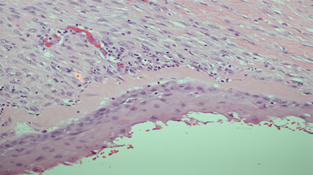 Middle power microscopic view of the cyst showing a lining of squamous epithelium with underlying partly hyalinized fibrous connective tissue and inflammation. Hematoxylin and eosin staining, ×200.
