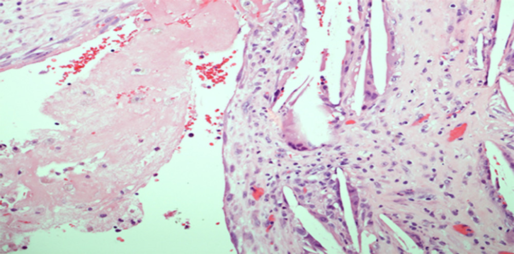 Part of the cyst was lined by fibrinous material with cholesterol clefts and giant cells, which are indicative of old hemorrhage. Hematoxylin and eosin staining, ×200.