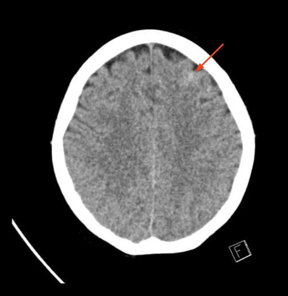 NCCT brain showing minimal left frontal convexity SAH (red arrow), which can occur secondary to rupture of small arteries in cases of RCVS.