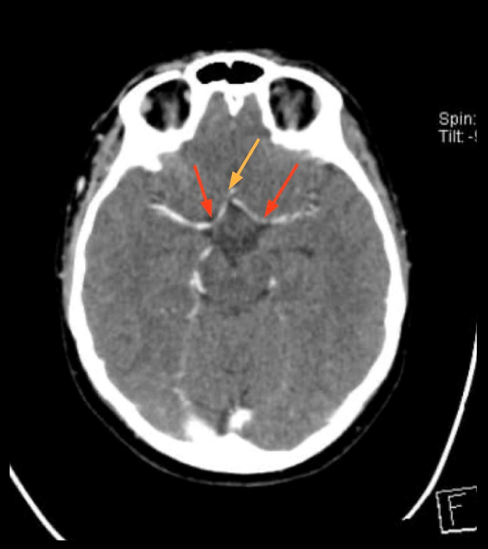 CT angiogram of intracranial arteries showing significant vasoconstriction in bilateral MCA (red arrows) and bilateral A1 from ACA (yellow arrow). Vasoconstriction of cerebral arteries on angiographic studies is a key diagnostic feature of RCVS.