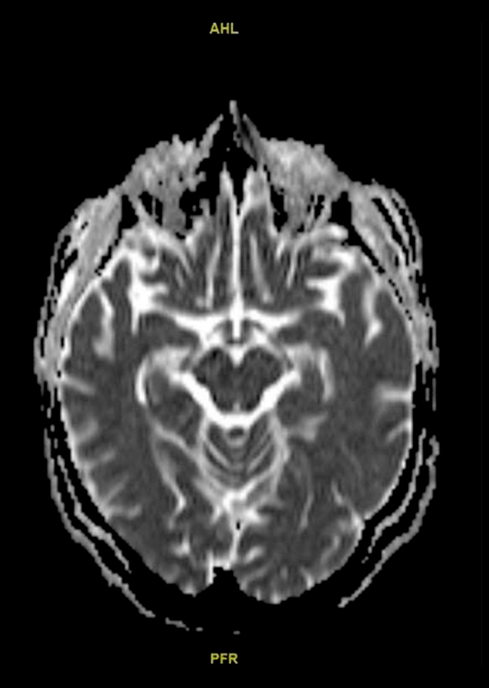 ADC MRI brain showing resolution of convexity SAH with no vasogenic edema or diffusion restriction.
