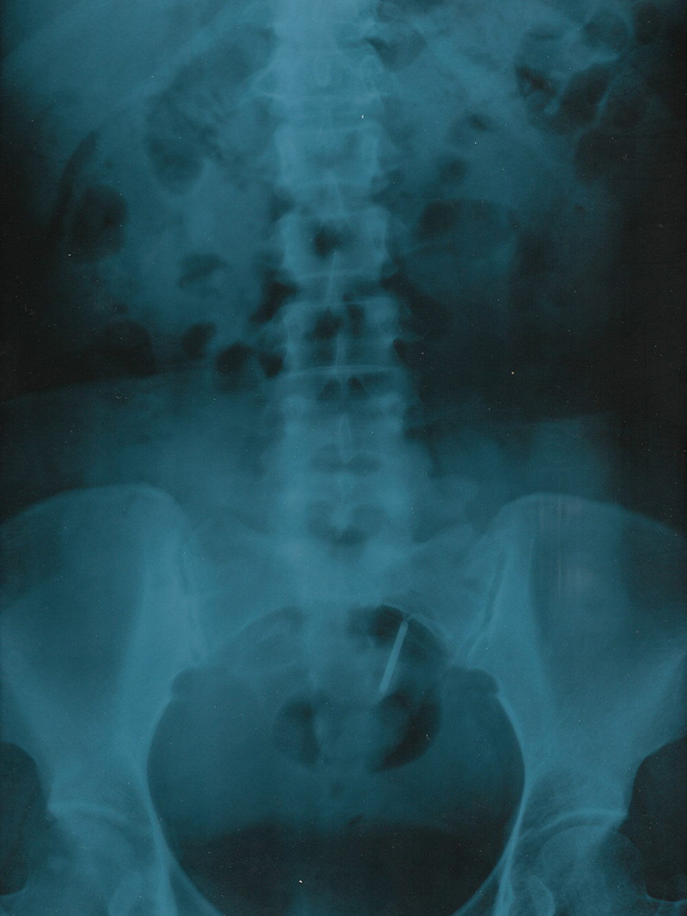 Plain abdominal radiograph showing the intrauterine device, which is to be pulled upward and obliquely because of the anatomical distortion of the uterus due to the adhesion to the abdominal wall.
