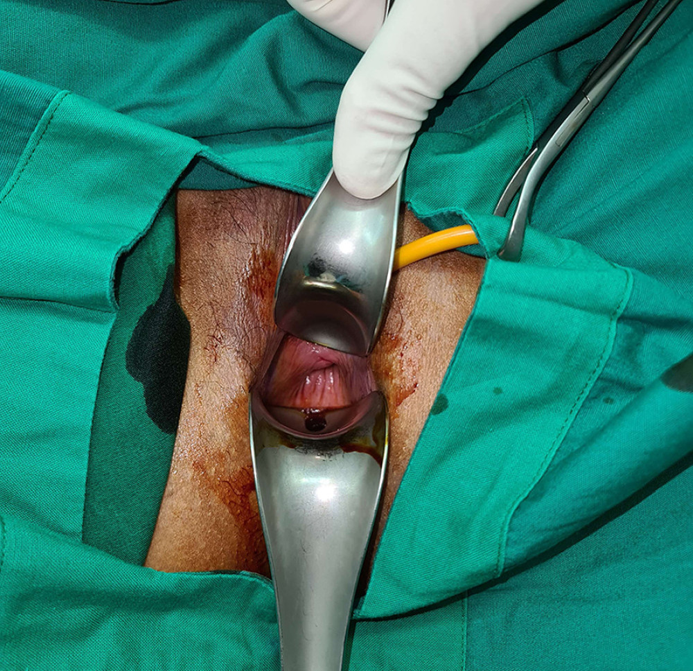 The cervix could not be visualized during evaluation under anesthesia in the operating theater. It was retracted cranially.