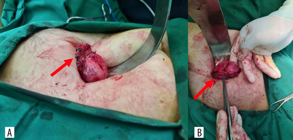 The uterus is pulled upward and adheres to the abdominal wall below the Pfannenstiel incision of the previous cesarean deliveries. The adhesion site (arrow) viewed from (A) left side and from (B) below.