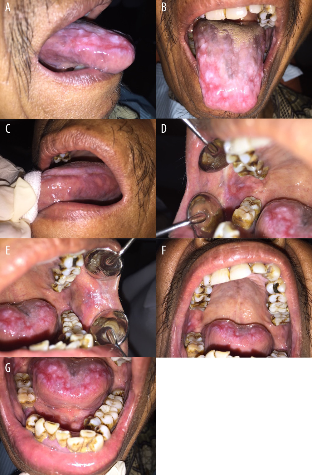 Clinical findings from the first visit. Erosion and erythematous areas surrounded by Wickham’s striae were found on the dorsal and lateral of the tongue and buccal mucosa (A–E). We also found that the dorsal anterior of the tongue was depapillated and stiff on palpation (A–C). Thick plaque, calculus, and stains were visible on the upper and lower teeth (F, G).