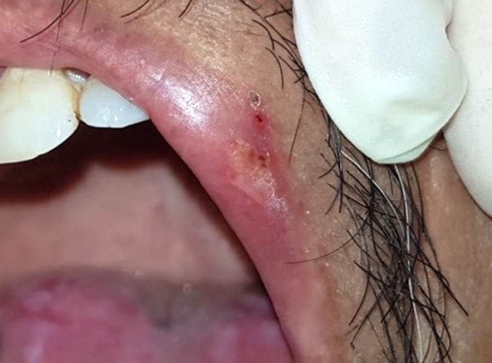 Crusted ulcer on the left upper lip.