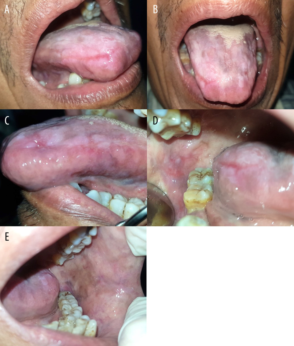 Patient’s oral findings (the tongue [A–C], left upper lip [B], and buccal mucosa [D, E]) on the fourth month of control, showing improvement after acyclovir administration.