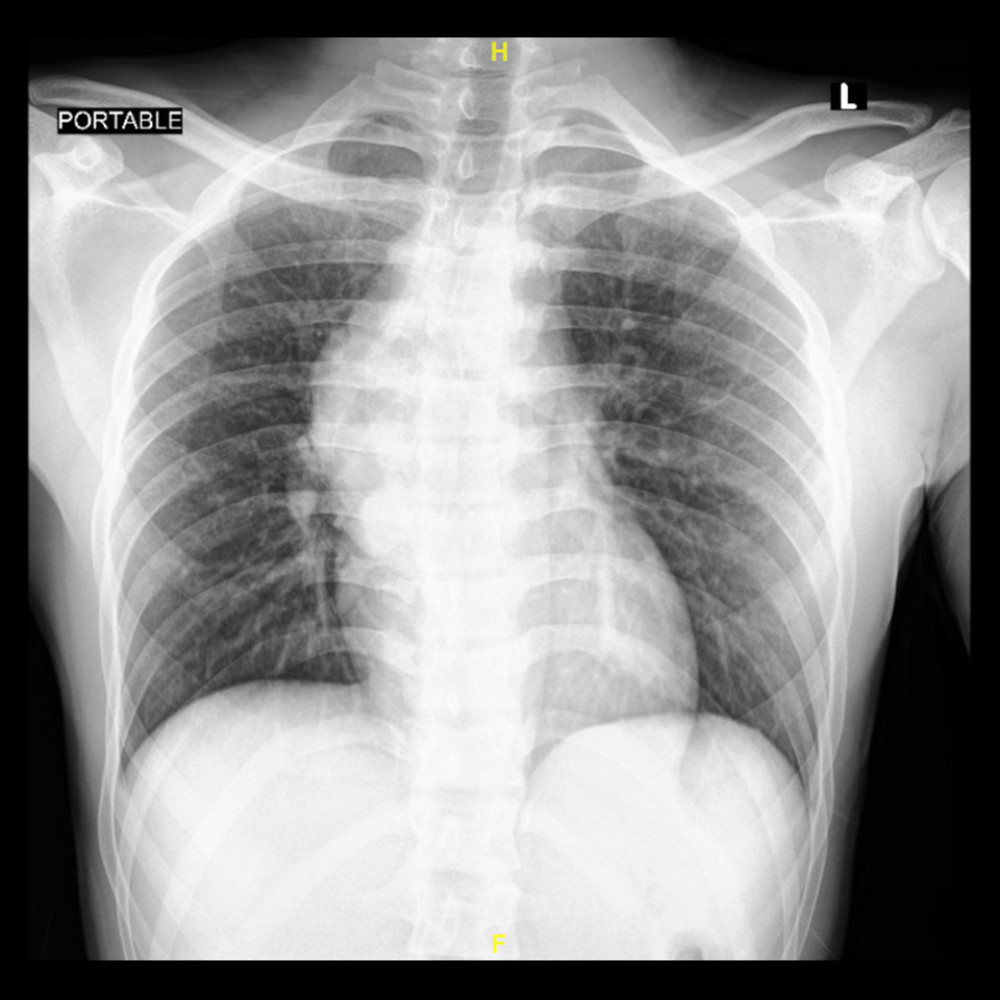 A posteroanterior chest X-ray showing widening of the mediastinum.