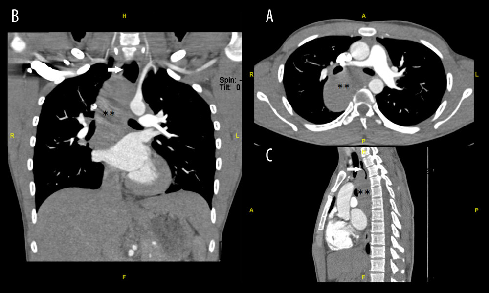 Axial computed tomography of the chest A: with contrast, B: with coronal reconstruction, and C: with sagittal reconstruction showing a large, posterior, mediastinal mass (double asterisk). There is severe narrowing of the esophageal lumen and a dilated superior esophageal segment (white arrow).