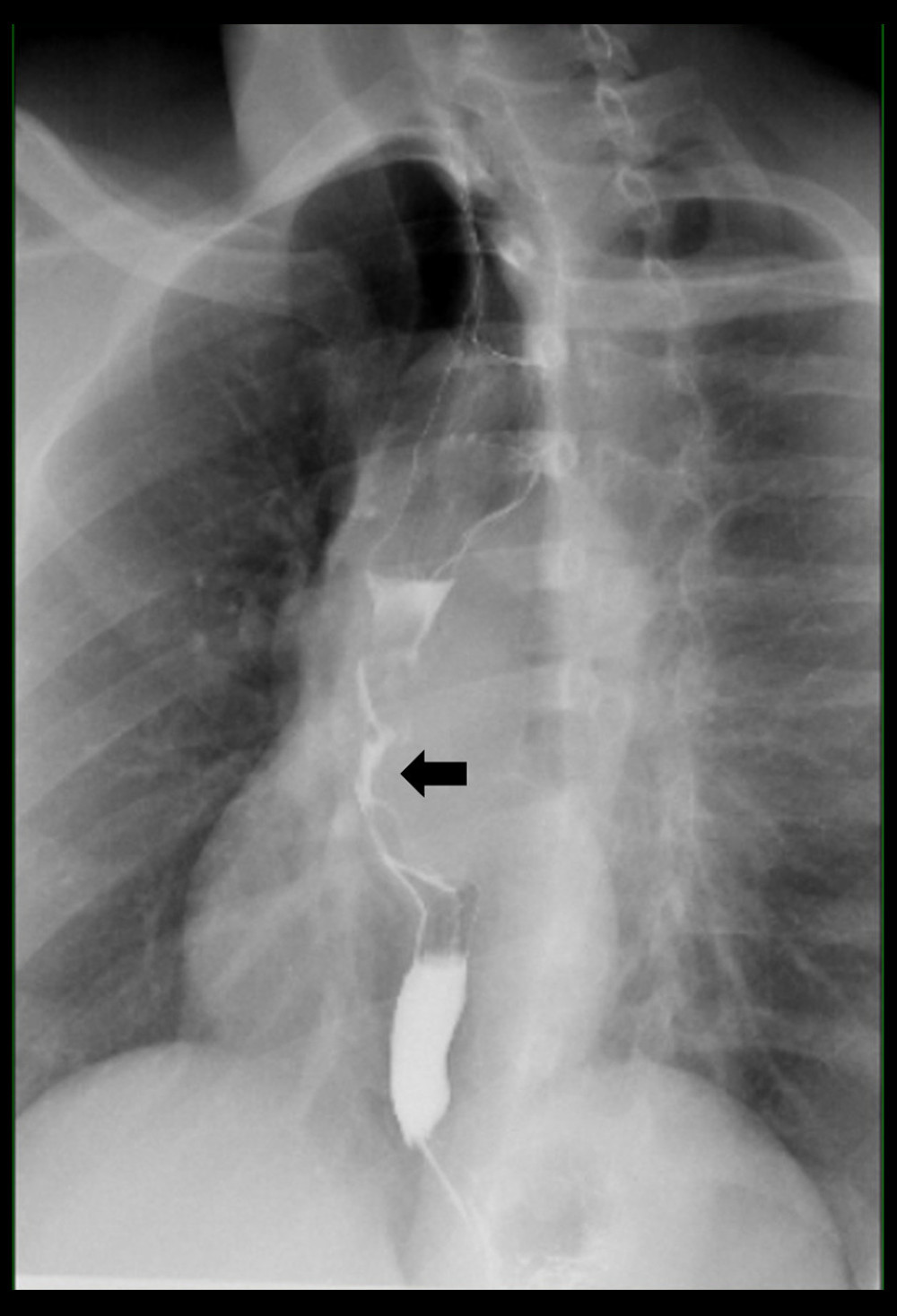 A preoperative barium swallow study showing a giant esophageal leiomyoma that is associated with midesophageal narrowing (black arrow) and deviation of the esophagus to the right.